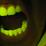 Teeth fluorescing